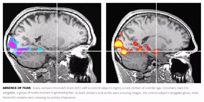 Alex Honnold brain scan