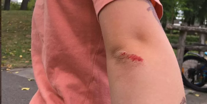 Child's scraped elbow after falling off a skateboard